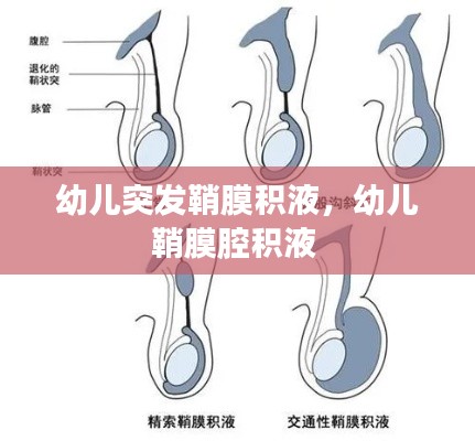 幼兒突發(fā)鞘膜積液，幼兒鞘膜腔積液 