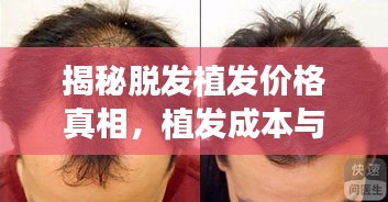 揭秘脫發(fā)植發(fā)價格真相，植發(fā)成本與最佳方案選擇全解析